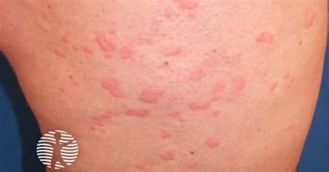 dermznet|dermnet urticaria.